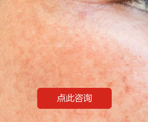 其它皮肤病