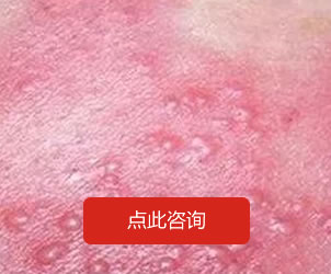 带状疱疹