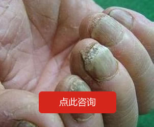 灰指甲