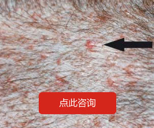 毛囊炎