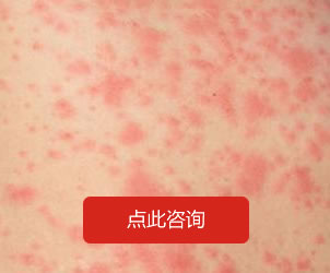 皮肤过敏