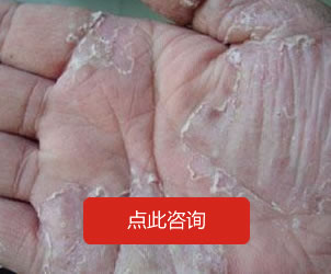 手足癣